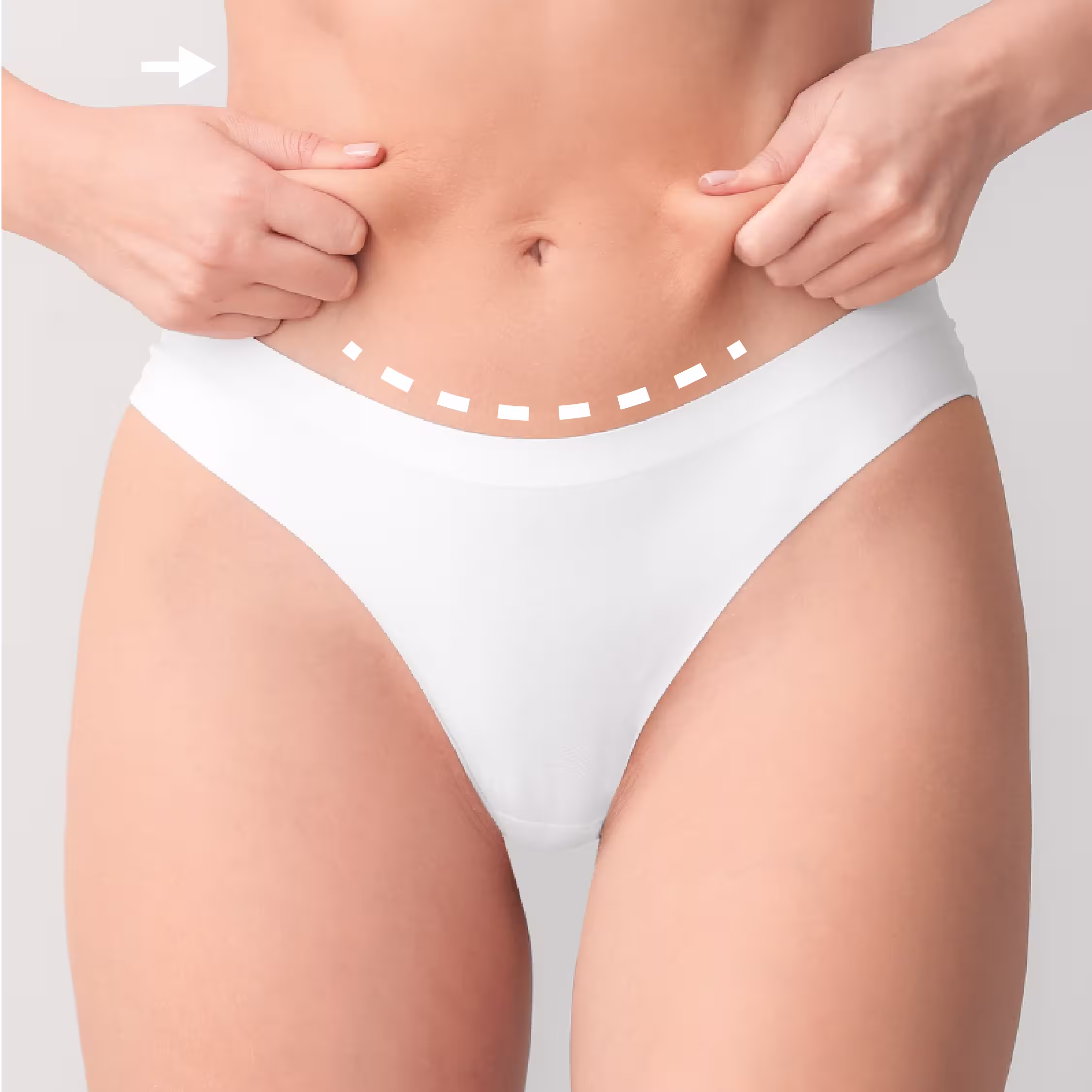 Tummy Tuck